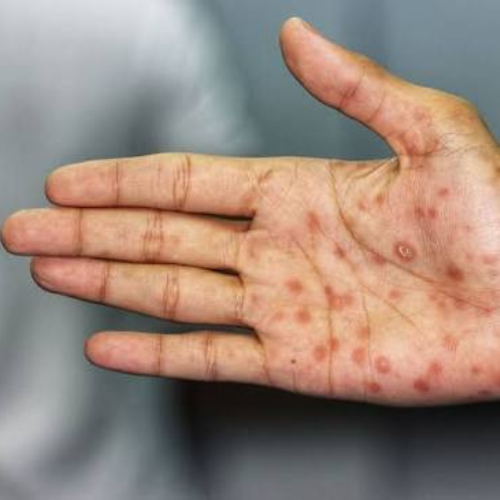 El Ministerio de Salud confirmó un aumento del 64% de los casos de sífilis en el país